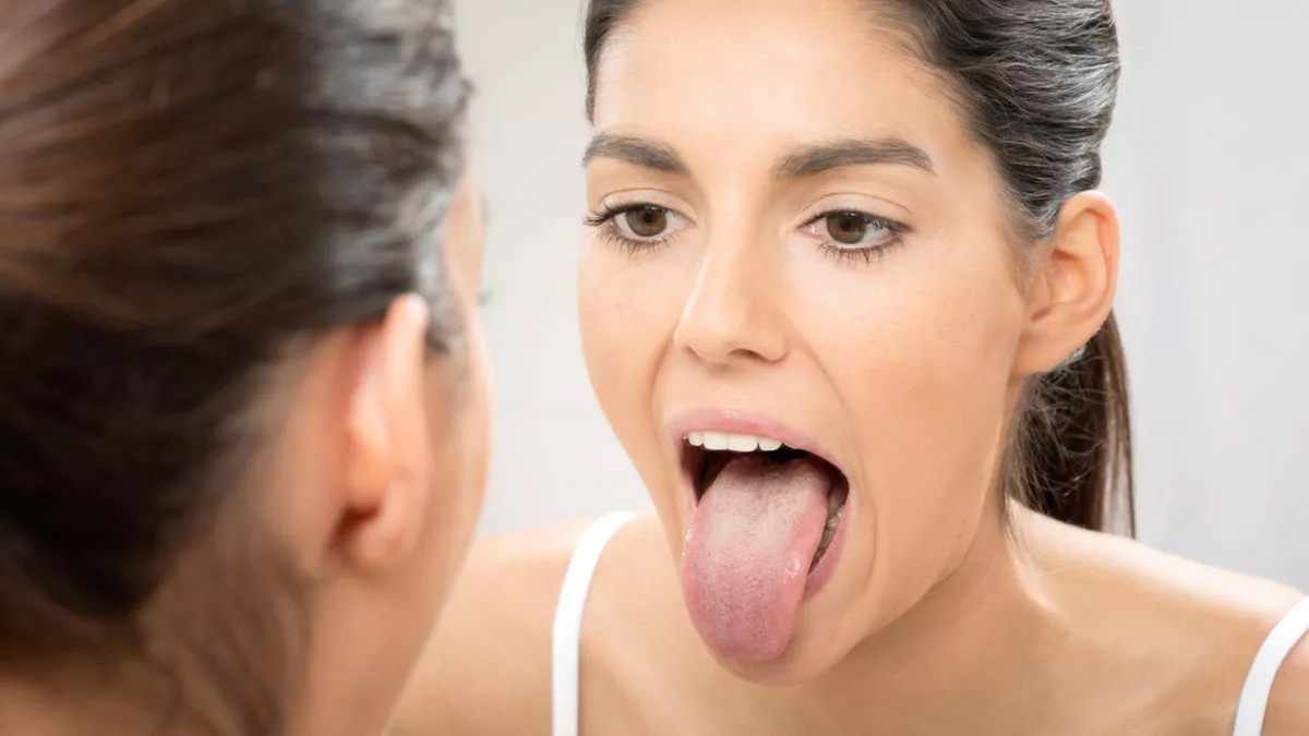 Tongue Cancer